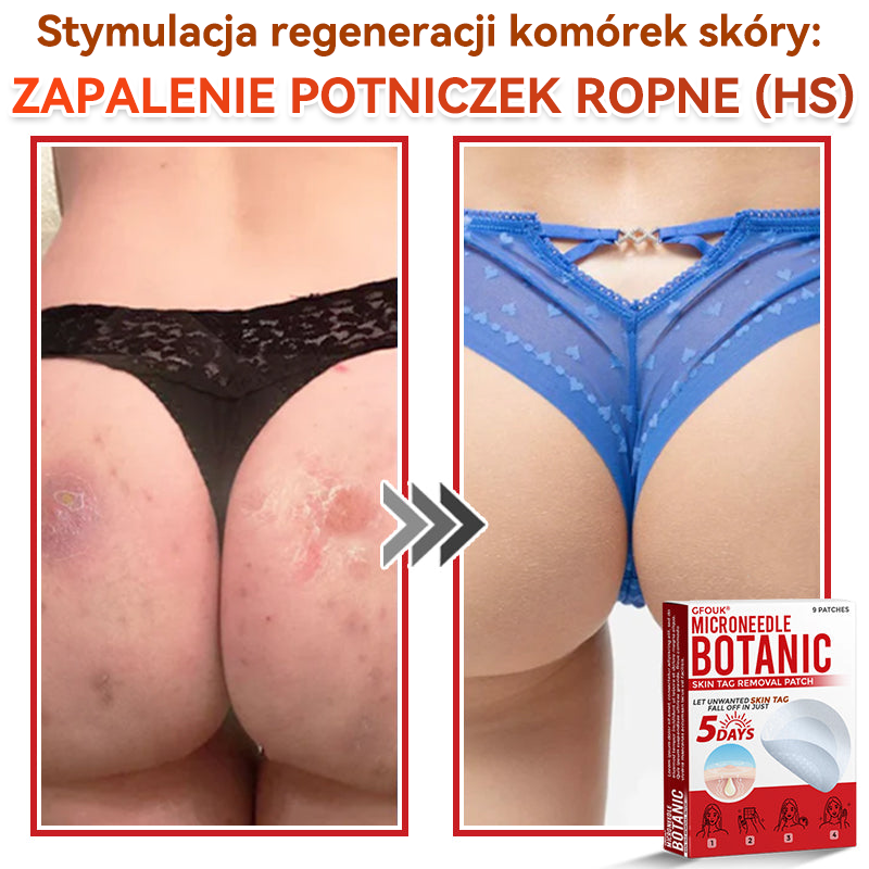 🎁 Zostało już tylko 5 opakowań! Teraz możesz otrzymać dodatkowe 50% ZNIŻKI! Pomaga widocznie zmniejszyć włókniaki, brodawki i inne niedoskonałości skóry — szybko, wygodnie i bez bólu. 🌿
