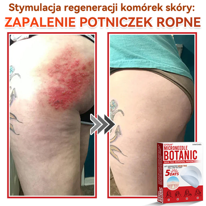 🎁 Zostało już tylko 5 opakowań! Teraz możesz otrzymać dodatkowe 50% ZNIŻKI!  Pomaga widocznie zmniejszyć włókniaki, brodawki i inne niedoskonałości skóry — szybko, wygodnie i bez bólu. 🌿