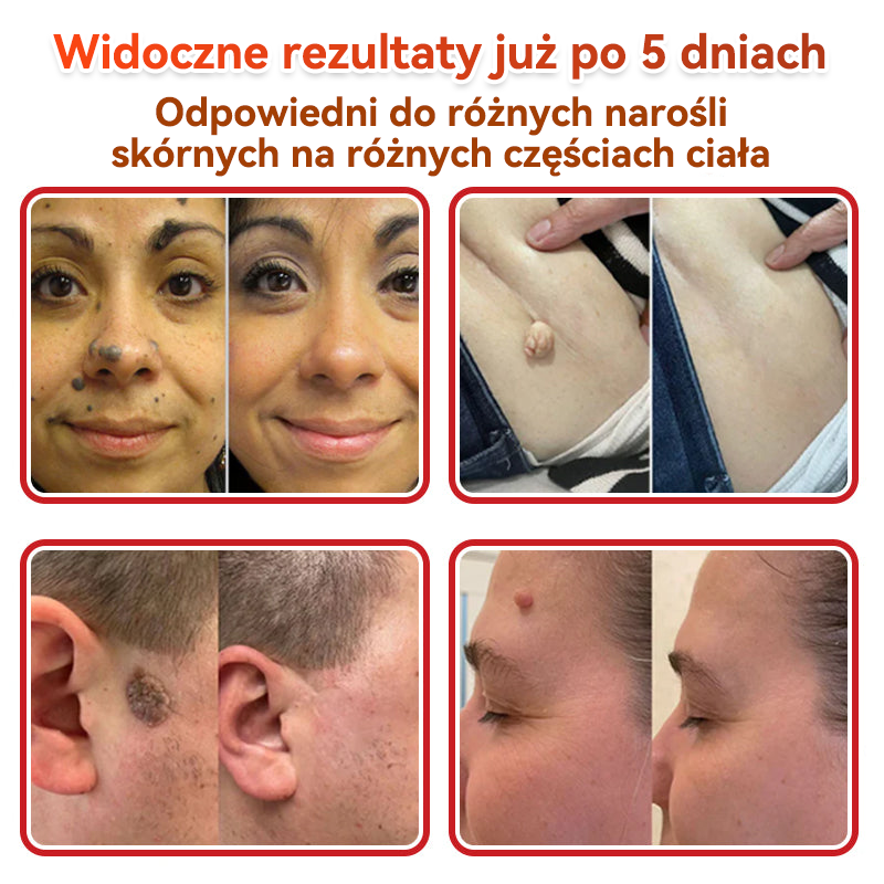 🎁 Zostało już tylko 5 opakowań! Teraz możesz otrzymać dodatkowe 50% ZNIŻKI!  Pomaga widocznie zmniejszyć włókniaki, brodawki i inne niedoskonałości skóry — szybko, wygodnie i bez bólu. 🌿