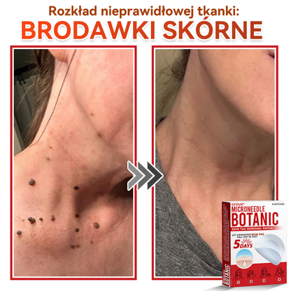 🎁 Zostało już tylko 5 opakowań! Teraz możesz otrzymać dodatkowe 50% ZNIŻKI!  Pomaga widocznie zmniejszyć włókniaki, brodawki i inne niedoskonałości skóry — szybko, wygodnie i bez bólu. 🌿