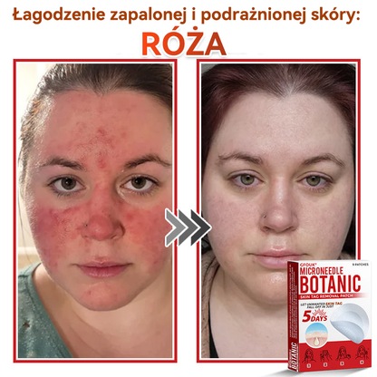 🎁 Zostało już tylko 5 opakowań! Teraz możesz otrzymać dodatkowe 50% ZNIŻKI!  Pomaga widocznie zmniejszyć włókniaki, brodawki i inne niedoskonałości skóry — szybko, wygodnie i bez bólu. 🌿