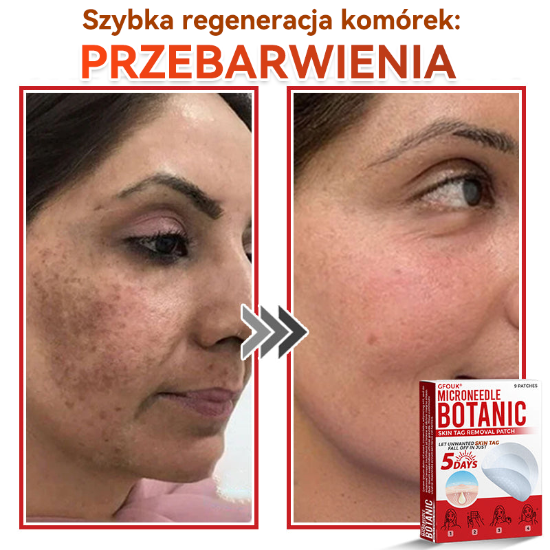 🎁 Zostało już tylko 5 opakowań! Teraz możesz otrzymać dodatkowe 50% ZNIŻKI!  Pomaga widocznie zmniejszyć włókniaki, brodawki i inne niedoskonałości skóry — szybko, wygodnie i bez bólu. 🌿