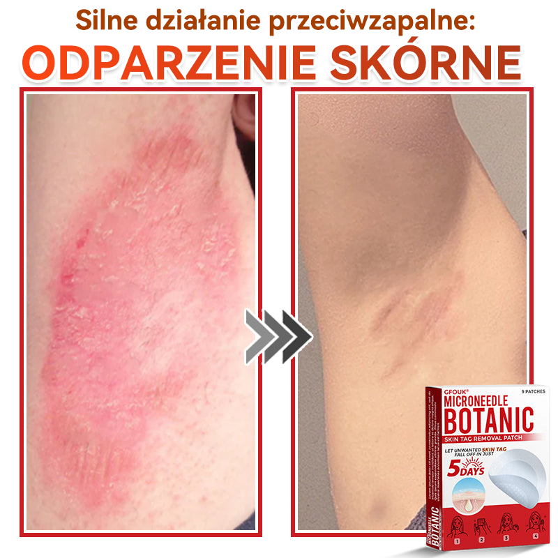 🎁 Zostało już tylko 5 opakowań! Teraz możesz otrzymać dodatkowe 50% ZNIŻKI!  Pomaga widocznie zmniejszyć włókniaki, brodawki i inne niedoskonałości skóry — szybko, wygodnie i bez bólu. 🌿